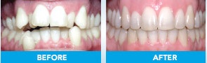 Damon braces before and after example 4
