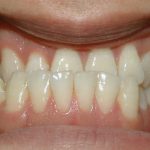 Underbite before orthodontic care