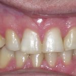 Teeth with Spacing After Braces