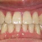 Spacing teeth after orthodontic treatment
