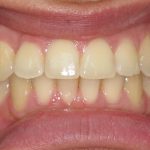 overjet teeth after braces