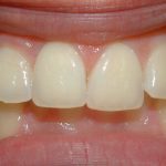 Over jet teeth before braces