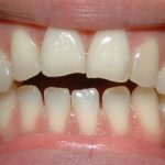 teeth with open bite before braces