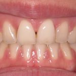 Teeth With Open Bite After Braces