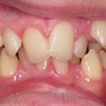 Teeth with crossbite before braces