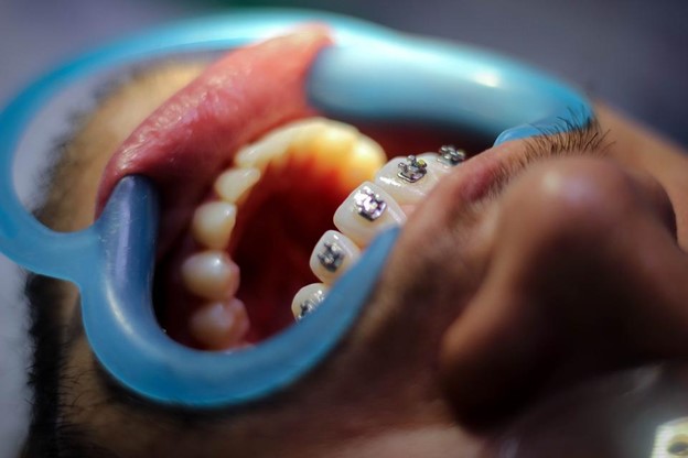 Man having metal braces fit by orthodontist