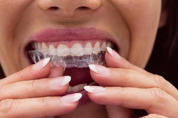 Woman putting in her Invisalign orthodontic aligners