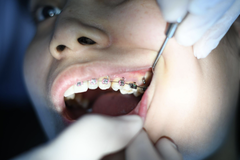 a woman's braces getting cleaned
