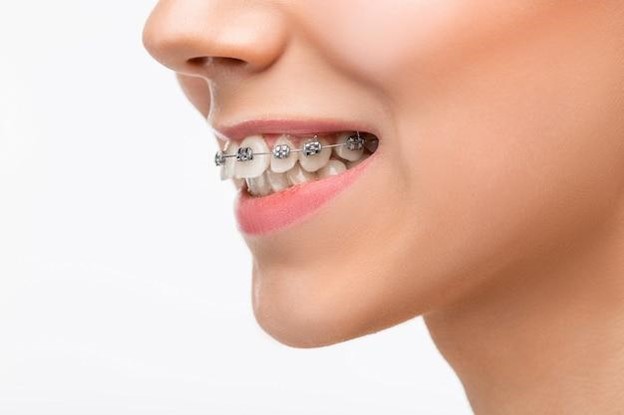 Up close of braces on teeth