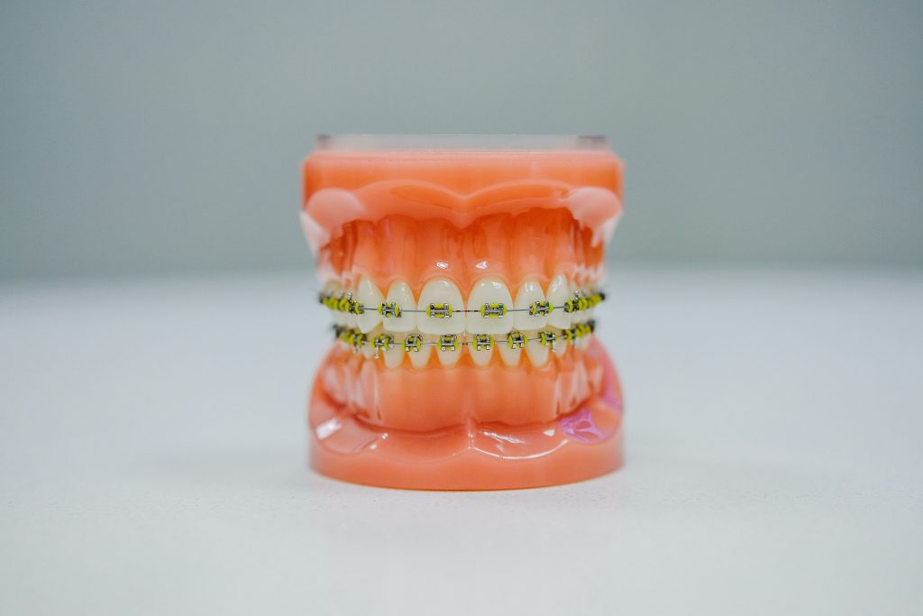 braces on a model of teeth