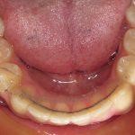Crowded Teeth After HOP Treatment