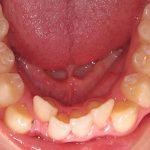 Crowded Teeth Before HOP Treatment
