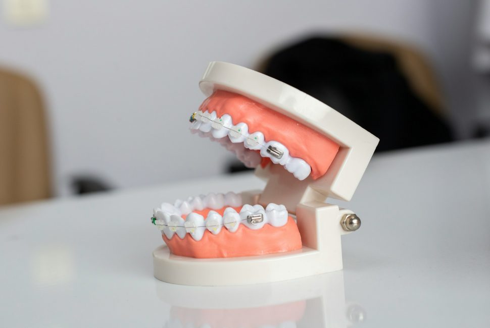 Example of Damon Braces on a teeth model